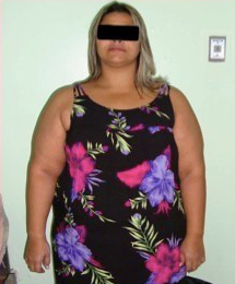 29 yr old female treated for severe obesity before 1091297