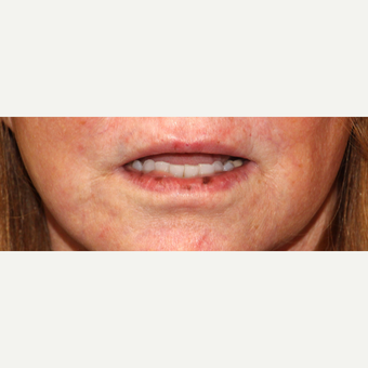 45-54 year old woman treated with Laser Treatment before 3110385