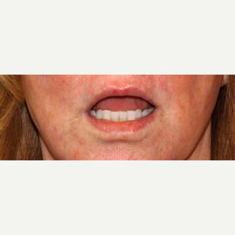45-54 year old woman treated with Laser Treatment after 3110385