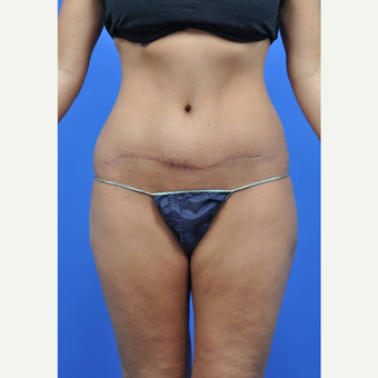 25-34 year old woman treated with Tummy Tuck after 3449711