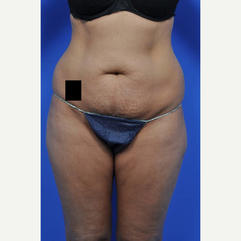 25-34 year old woman treated with Tummy Tuck before 3449711