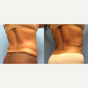 62 year old woman treated with Liposuction of the abdomen and waist before 3174530