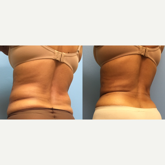 62 year old woman treated with Liposuction of the abdomen and waist after 3174530