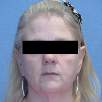 45-54 year old woman treated with Voluma & Juvederm before 3293206