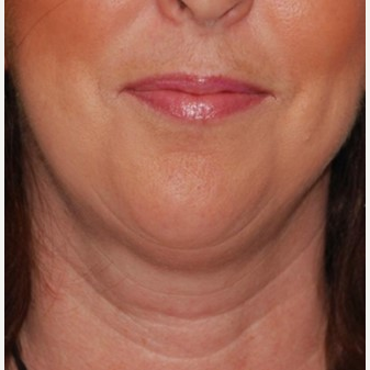 35-44 year old woman treated with Chin Implant & Neck Lift before 3649796
