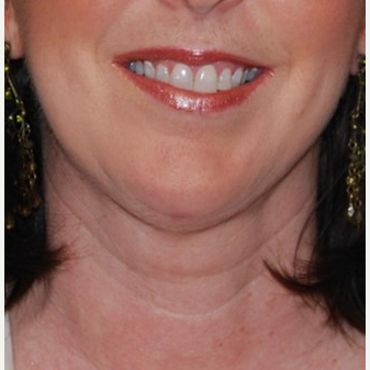 35-44 year old woman treated with Chin Implant & Neck Lift after 3649796