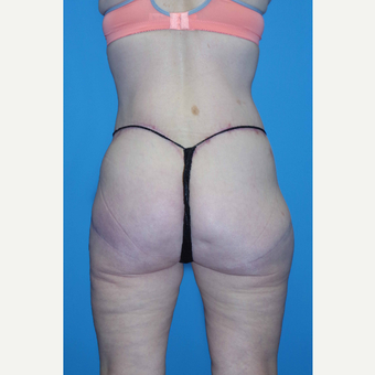 55-64 year old woman treated with Body Lift after 2864147