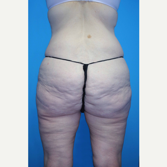 55-64 year old woman treated with Body Lift before 2864147