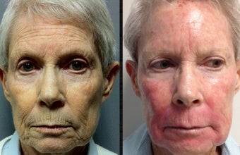 70+ Year Old Female Treated for Pigment, Texture and Wrinkles before 1198947