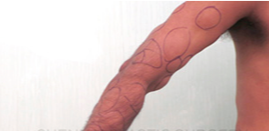 25-34 year old man treated with Lipoma Removal before 2466518