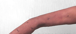25-34 year old man treated with Lipoma Removal after 2466518