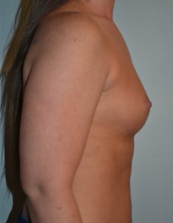 25-34 year old woman treated with Breast Reconstruction 3104593