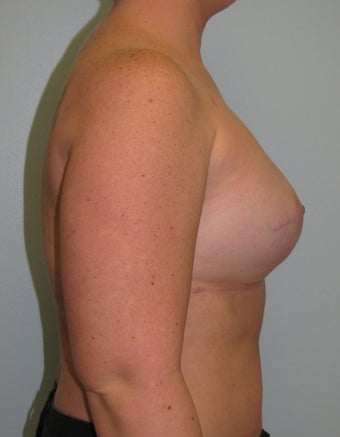 25-34 year old woman treated with Breast Reconstruction 3104593