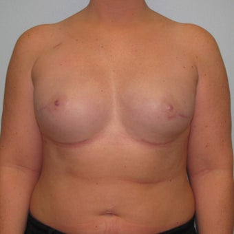25-34 year old woman treated with Breast Reconstruction after 3104593