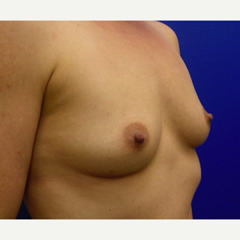 25-34 year old woman treated with Breast Implants before 3669900