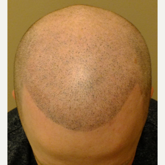 25-34 year old man treated with Micropigmentation after 2827062