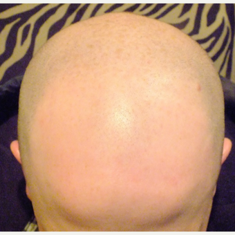 25-34 year old man treated with Micropigmentation before 2827062