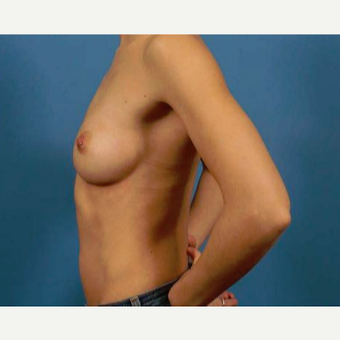 25-34 year old woman treated with Breast Augmentation before 3786957