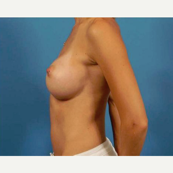 25-34 year old woman treated with Breast Augmentation after 3786957
