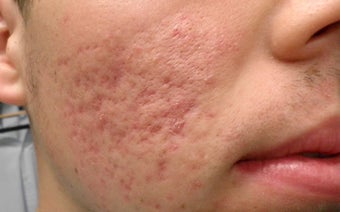 Acne scars no more before 1440892