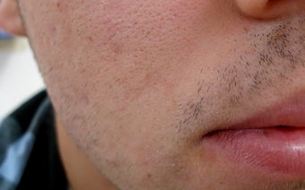 Acne scars no more after 1440892