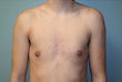 Male patient who underwent breast reduction after 925570