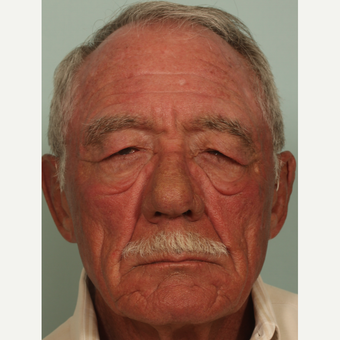 65-74 year old man treated with Eyelid Surgery before 3589427