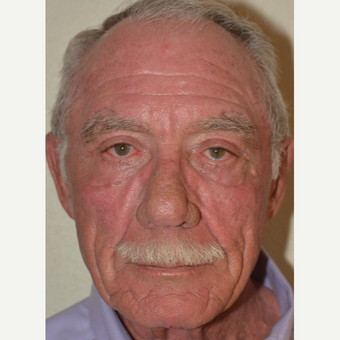 65-74 year old man treated with Eyelid Surgery after 3589427