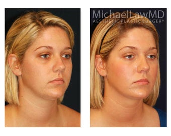 Chin Liposuction before 1256344