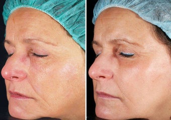 Fractional Laser Skin Resurfacing before 69338