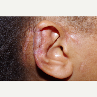 17 or under year old female treated with Ear Surgery after 3741628