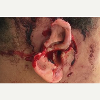 17 or under year old female treated with Ear Surgery before 3741628