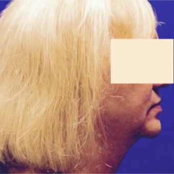 57 year old woman treated with CoolSculpting after 2853704