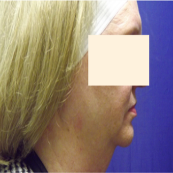 57 year old woman treated with CoolSculpting before 2853704