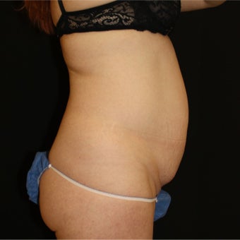 35-44 year old woman treated with Tummy Tuck 1900093