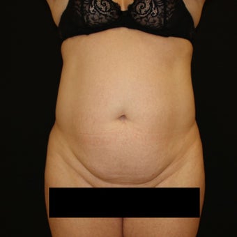 35-44 year old woman treated with Tummy Tuck before 1900093