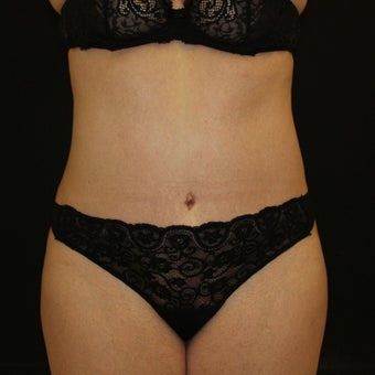 35-44 year old woman treated with Tummy Tuck after 1900093