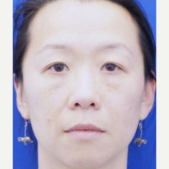 35-44 year old woman treated with Ptosis Surgery after 3727818