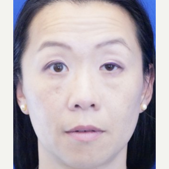 35-44 year old woman treated with Ptosis Surgery before 3727818