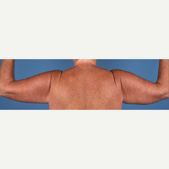 55-64 year old woman treated with Arm Lift after 3837603