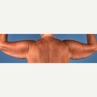 55-64 year old woman treated with Arm Lift before 3837603