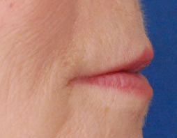 Restylane Lip Injection before 222100