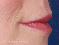 Restylane Lip Injection after 222100