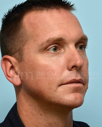 Non-Surgical Chin Augmentation Using Juvederm Voluma 1607161