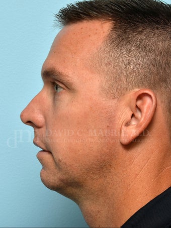 Non-Surgical Chin Augmentation Using Juvederm Voluma before 1607161