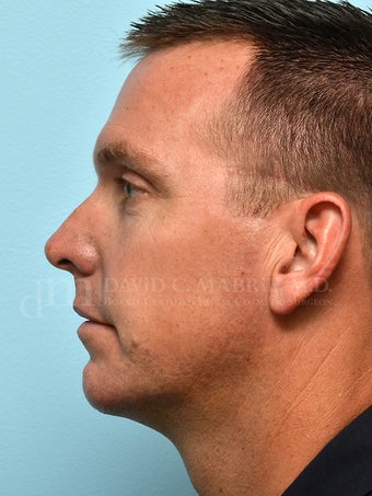 Non-Surgical Chin Augmentation Using Juvederm Voluma after 1607161