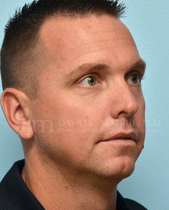 Non-Surgical Chin Augmentation Using Juvederm Voluma 1607161