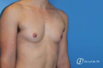18-24 year old man treated with FTM Chest Masculinization Surgery 2655982