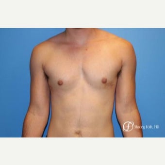 18-24 year old man treated with FTM Chest Masculinization Surgery after 2655982