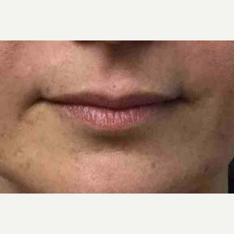 Female treated with Juvederm for Lip Augmentation before 3169137